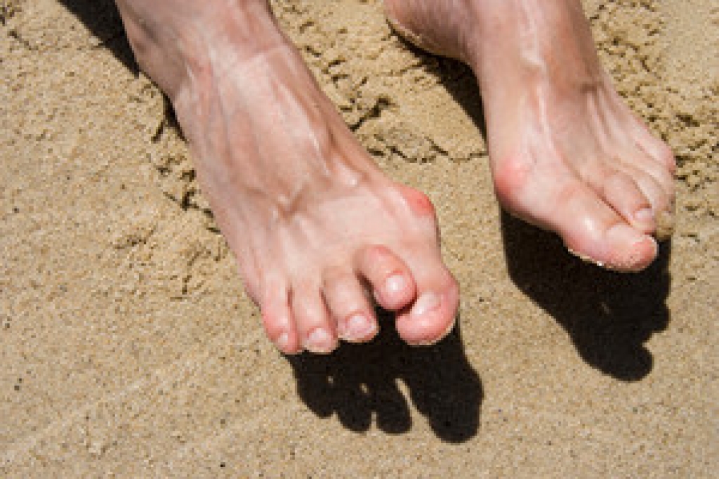 Causes and Professional Care for Hammertoe Deformity