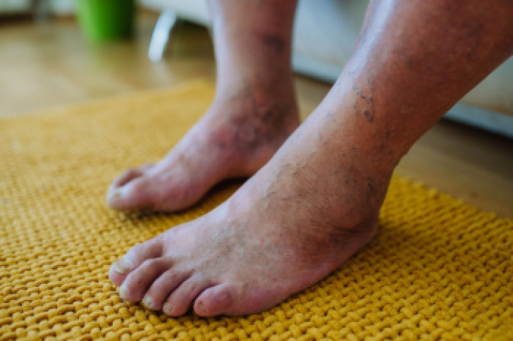 Why Diabetic Foot Care Is Essential for Healthy Feet