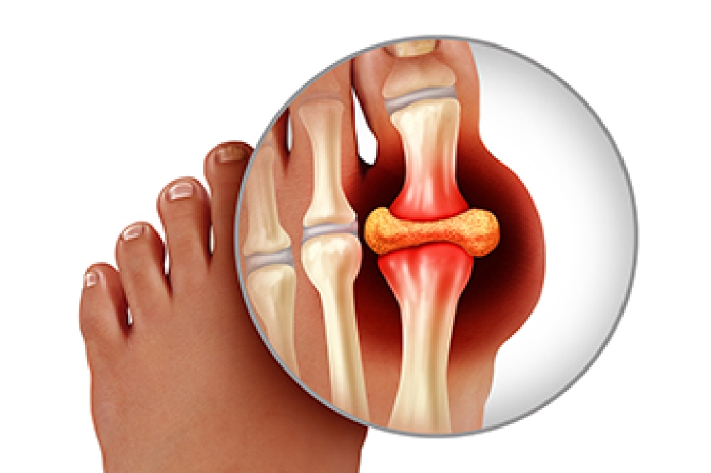 Gout and Its Triggers