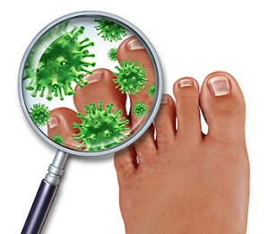 What Causes Athlete’s Foot?