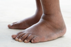 Common Reasons for Swollen Feet