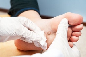What Do Plantar Warts Look Like?