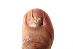 Risk Factors for Toenail Fungus
