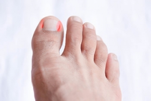 A Permanent Solution for Ingrown Toenails