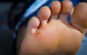What Is Hyperkeratosis?