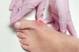 Care From a Podiatrist for Bunion Management