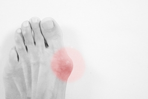 Possible Treatments for Bunions