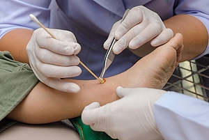 Debridement May Help Foot Ulcers Heal