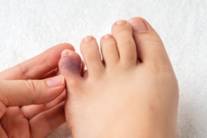 Broken Toes and How Early Care Supports Recovery