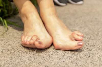 Early Signs of Rheumatoid Arthritis in the Feet