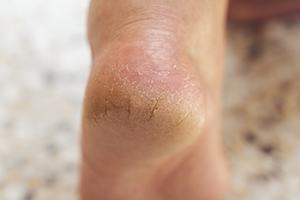 Cracked Heels and the Importance of Podiatric Foot Care