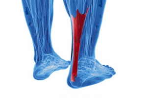 Achilles Tendon Bursitis