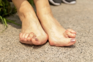 Early Rheumatoid Arthritis Symptoms in the Feet