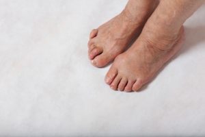 Hammertoe Relief Options