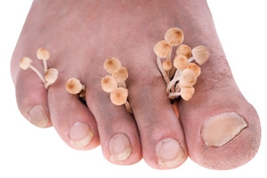 How to Prevent Athlete’s Foot