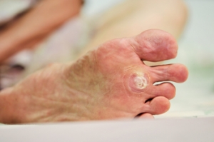 Where Do Plantar Warts Grow?