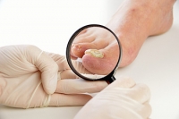 nail fungush foot megelőzése előkészületek