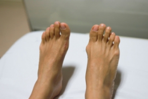 Bunions Are a Common Cause of Foot Pain