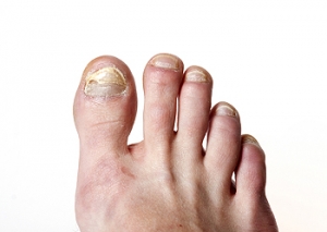 Options for Treating Toenail Fungus