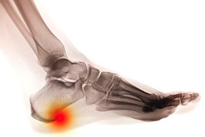 What Causes Heel Spurs?