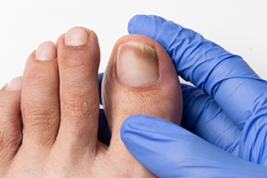 When Thick Yellow Toenails Signal a Fungal Infection