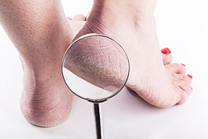Lack of Moisture in the Heel Pads May Cause Cracked Heels