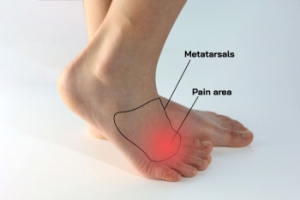 Definition and Relief Methods of Morton’s Neuroma
