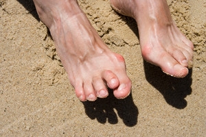 Symptoms of Hammertoe